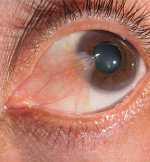 PTERYGIUM INFORMATION GUIDE
